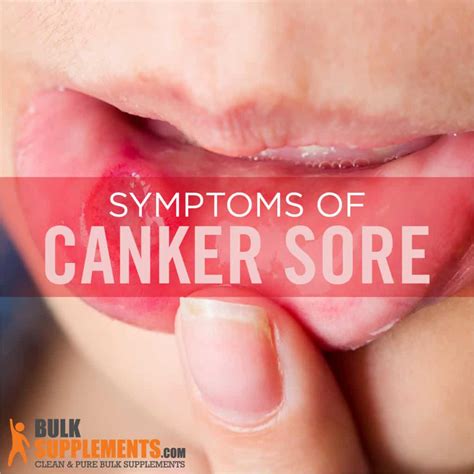 Canker Sores: Causes, Symptoms, Treatments, and Remedies.